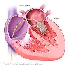 Valvuloplasty